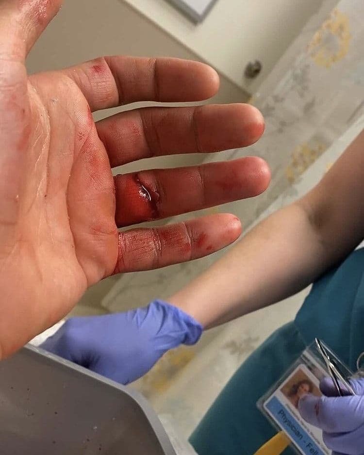 Боец ММА Хетаг Плиев во время поединка потерял палец